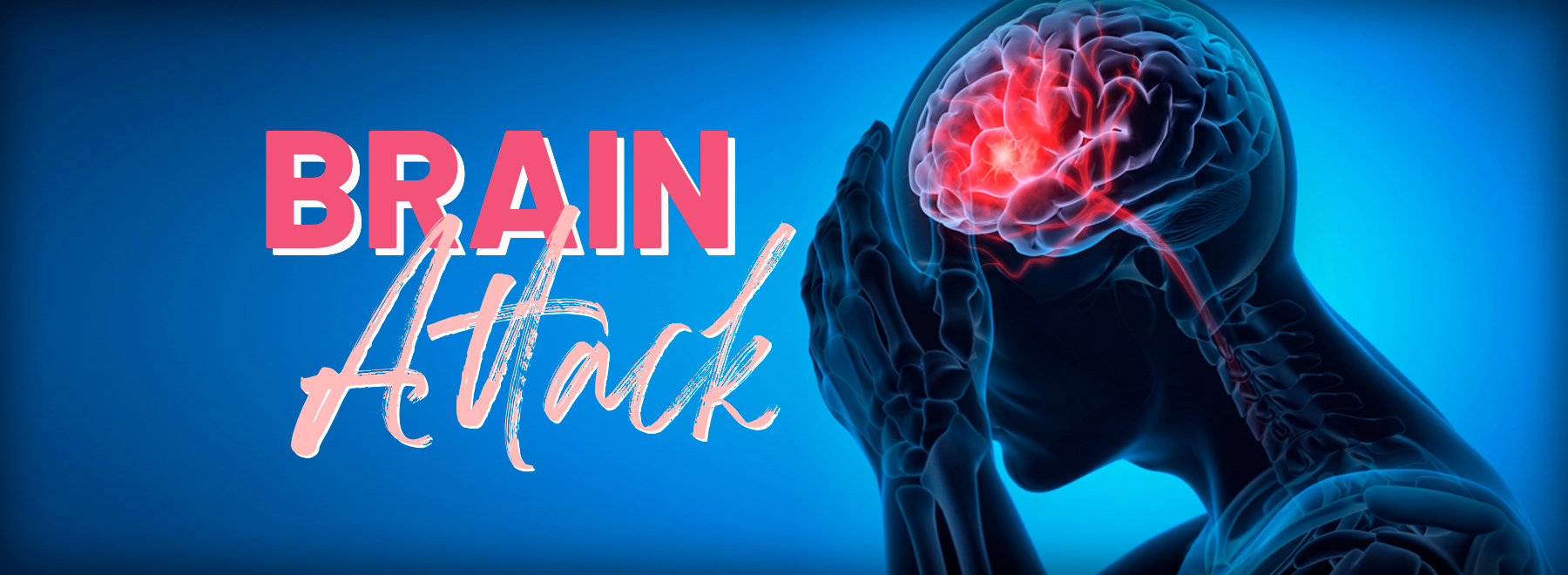 Xray image illustration of a stroke